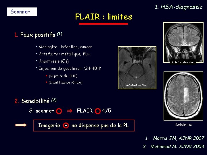 Scanner - 1. HSA-diagnostic FLAIR : limites 1. Faux positifs (1) • Méningite :