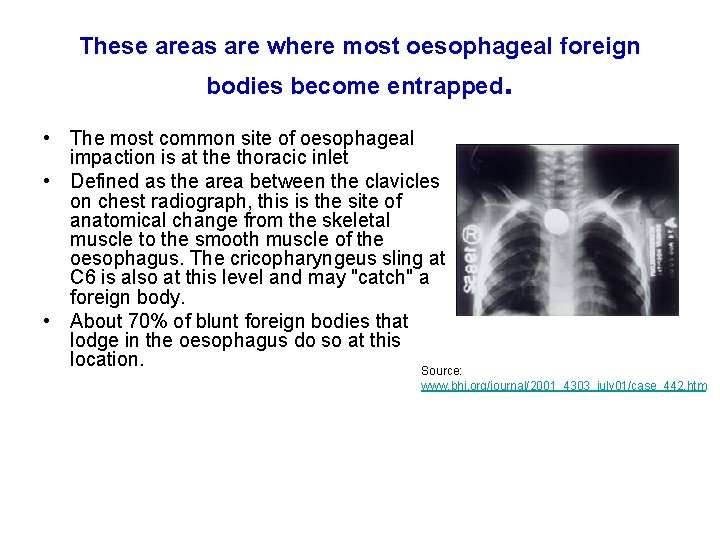 These areas are where most oesophageal foreign bodies become entrapped. • The most common These areas are where most oesophageal foreign bodies become entrapped. • The most common