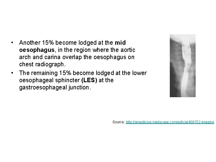 • Another 15% become lodged at the mid oesophagus, in the region where • Another 15% become lodged at the mid oesophagus, in the region where