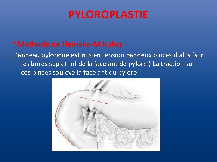 PYLOROPLASTIE *Méthode de Heineke-Mikulicz L’anneau pylorique est mis en tension par deux pinces d’allis