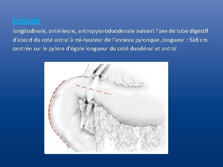 Incision longitudinale, antérieure, antropyloroduodenale suivant l’axe de tube digestif d’abord du coté antral à Incision longitudinale, antérieure, antropyloroduodenale suivant l’axe de tube digestif d’abord du coté antral à
