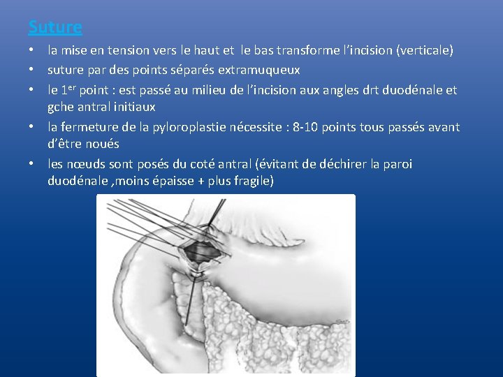 Suture • la mise en tension vers le haut et le bas transforme l’incision