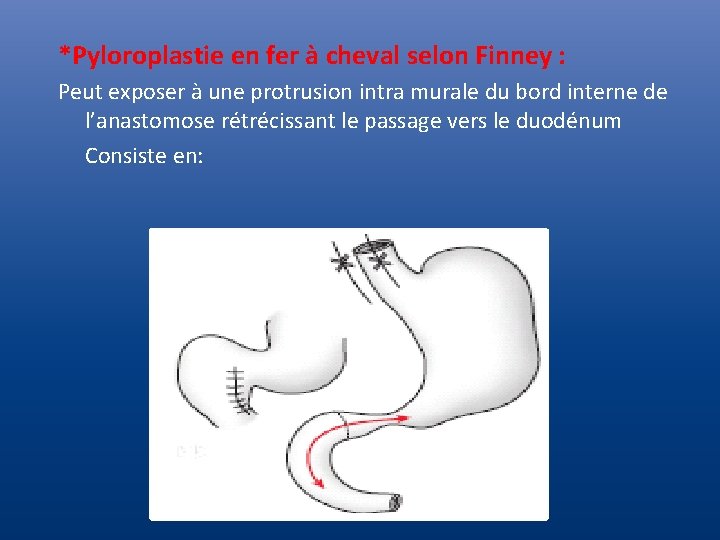 *Pyloroplastie en fer à cheval selon Finney : Peut exposer à une protrusion intra