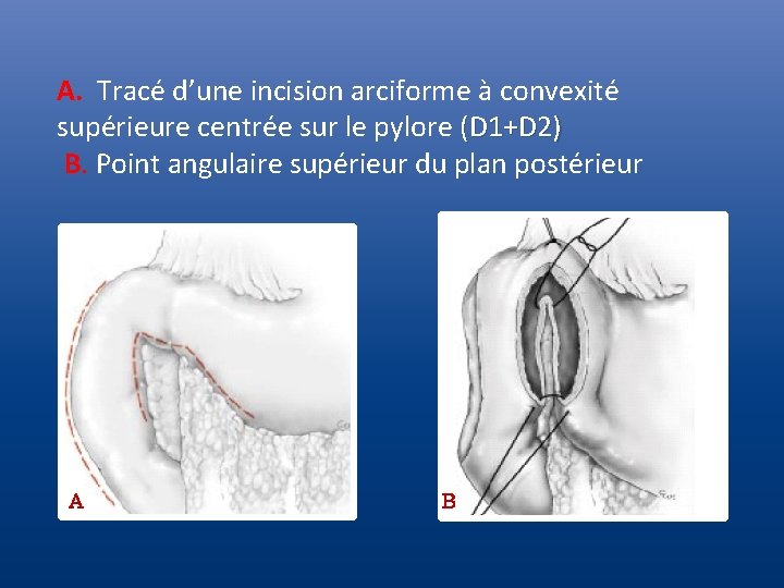 A. Tracé d’une incision arciforme à convexité supérieure centrée sur le pylore (D 1+D