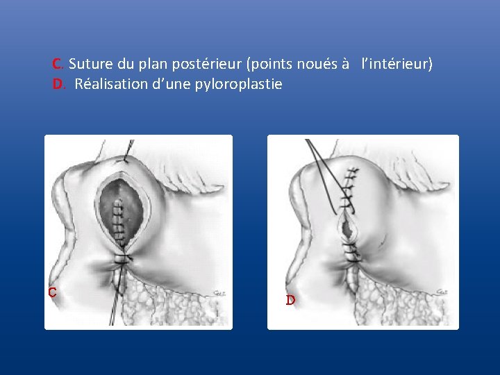 C. Suture du plan postérieur (points noués à l’intérieur) D. Réalisation d’une pyloroplastie C