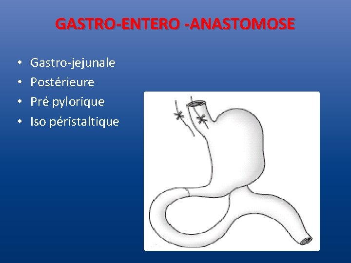 GASTRO-ENTERO -ANASTOMOSE • • Gastro-jejunale Postérieure Pré pylorique Iso péristaltique 