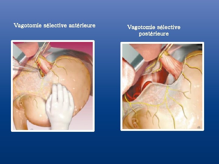 Vagotomie sélective antérieure Vagotomie sélective postérieure Vagotomie sélective antérieure Vagotomie sélective postérieure