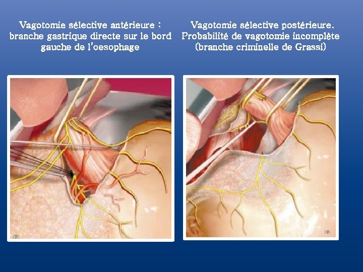 Vagotomie sélective antérieure : branche gastrique directe sur le bord gauche de l’oesophage Vagotomie