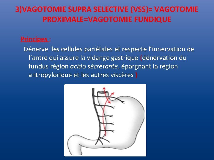 3)VAGOTOMIE SUPRA SELECTIVE (VSS)= VAGOTOMIE PROXIMALE=VAGOTOMIE FUNDIQUE Principes : Dénerve les cellules pariétales et