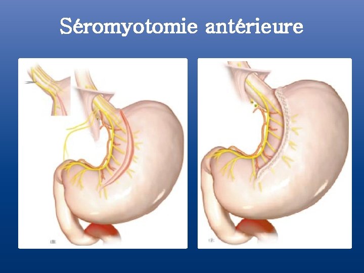 Séromyotomie antérieure 