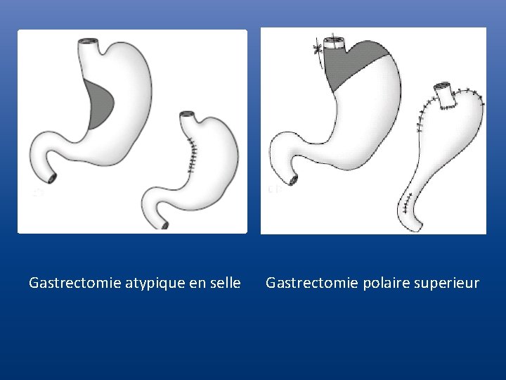 Gastrectomie atypique en selle Gastrectomie polaire superieur 