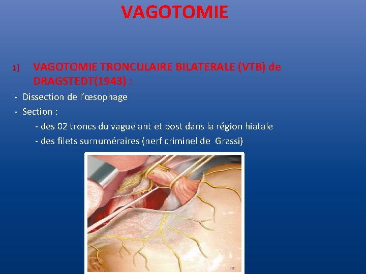  VAGOTOMIE 1) VAGOTOMIE TRONCULAIRE BILATERALE (VTB) de DRAGSTEDT(1943) : - Dissection de l’œsophage