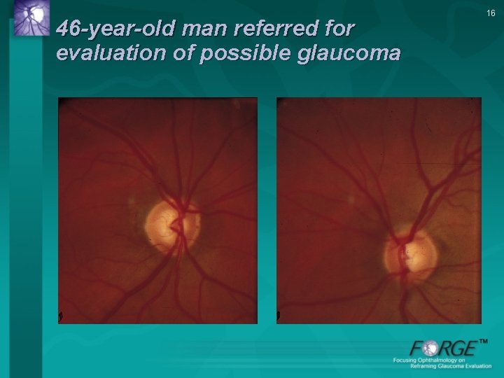 46 -year-old man referred for evaluation of possible glaucoma 16 