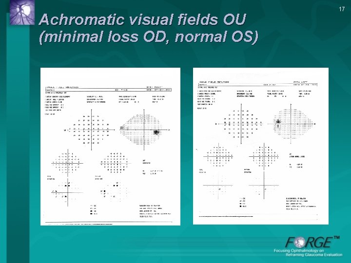 Achromatic visual fields OU (minimal loss OD, normal OS) 17 