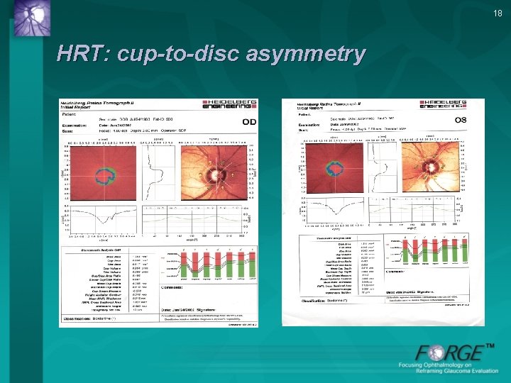 18 HRT: cup-to-disc asymmetry 