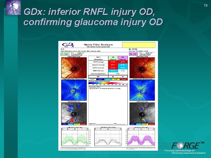 GDx: inferior RNFL injury OD, confirming glaucoma injury OD 19 