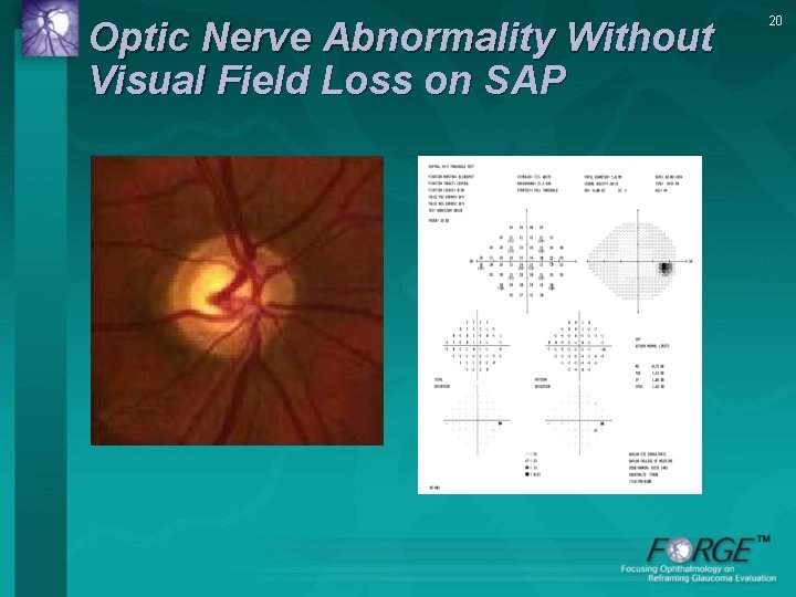 Optic Nerve Abnormality Without Visual Field Loss on SAP 20 