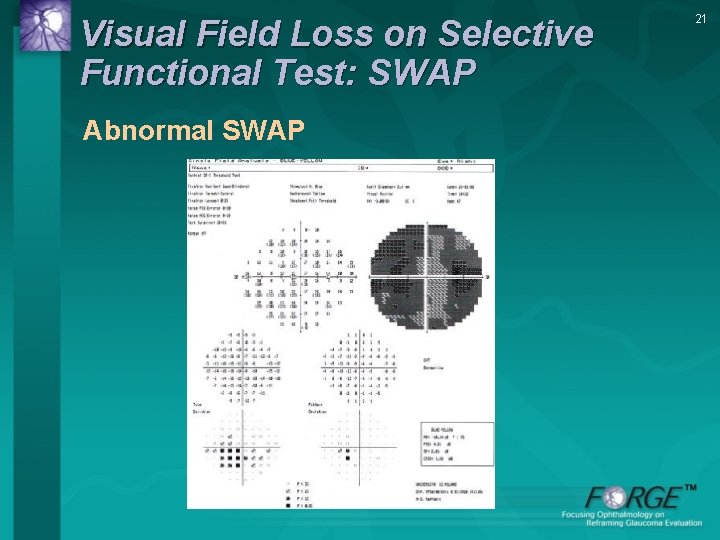 Visual Field Loss on Selective Functional Test: SWAP Abnormal SWAP 21 