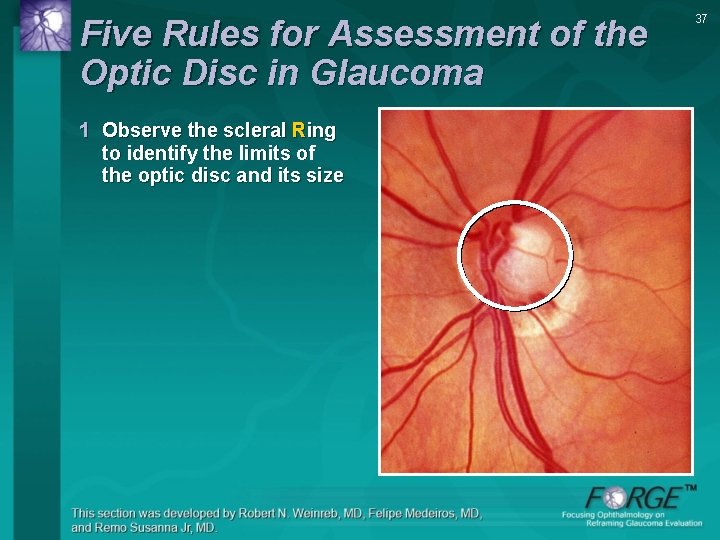 Five Rules for Assessment of the Optic Disc in Glaucoma 1 Observe the scleral