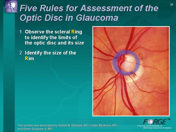 Five Rules for Assessment of the Optic Disc in Glaucoma 1 Observe the scleral