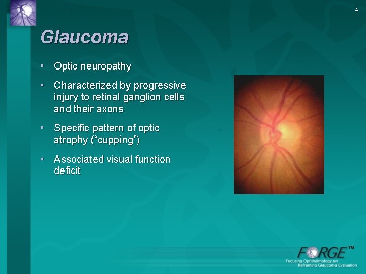 4 Glaucoma • Optic neuropathy • Characterized by progressive injury to retinal ganglion cells