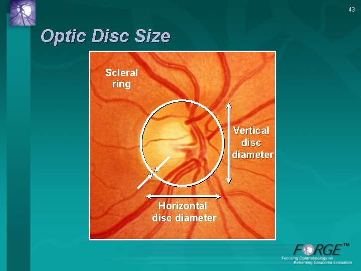 43 Optic Disc Size Scleral ring Vertical disc diameter Horizontal disc diameter 
