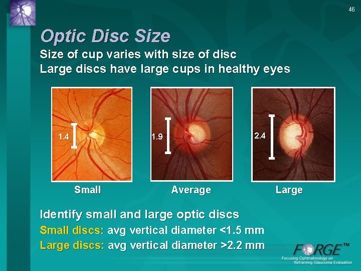 46 Optic Disc Size of cup varies with size of disc Large discs have