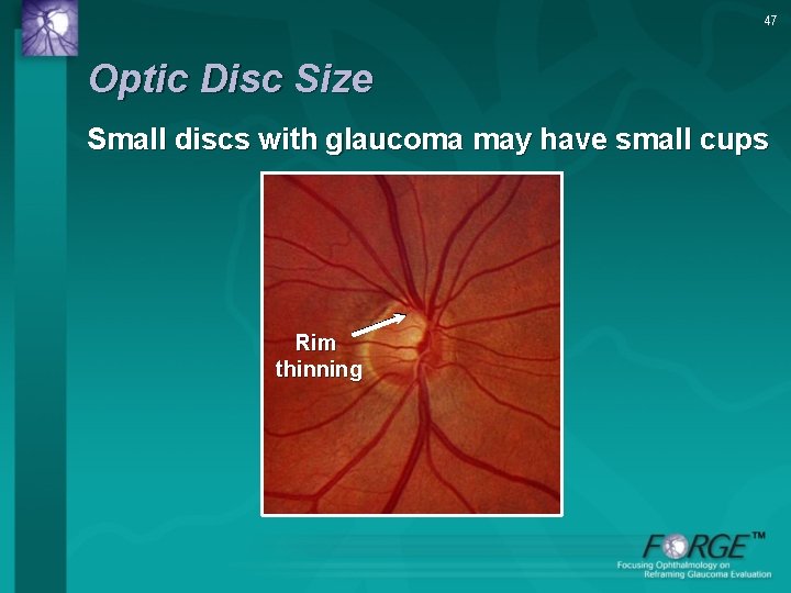 47 Optic Disc Size Small discs with glaucoma may have small cups Rim thinning