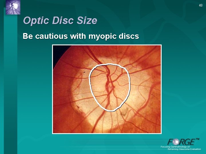 48 Optic Disc Size Be cautious with myopic discs 