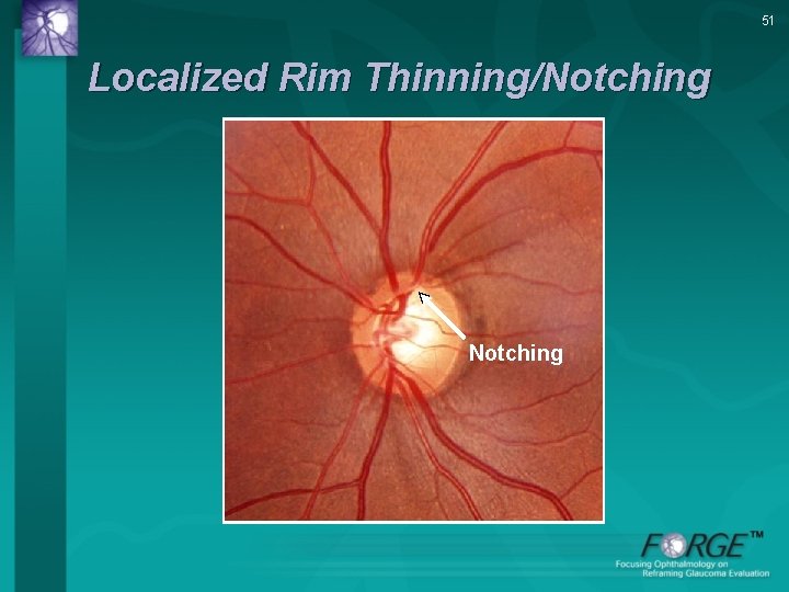 51 Localized Rim Thinning/Notching 
