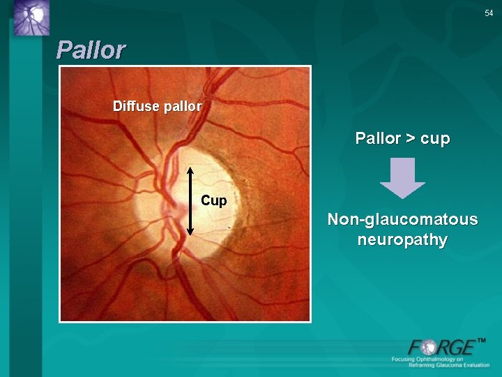 54 Pallor Diffuse pallor Pallor > cup Cup Non-glaucomatous neuropathy 