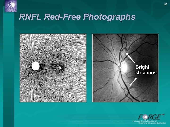 57 RNFL Red-Free Photographs Bright striations 