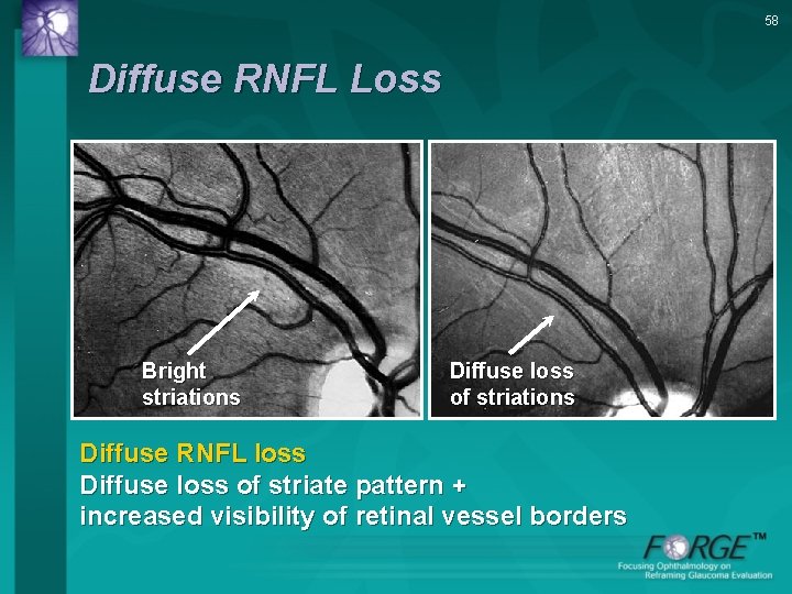 58 Diffuse RNFL Loss Bright striations Diffuse loss of striations Diffuse RNFL loss Diffuse