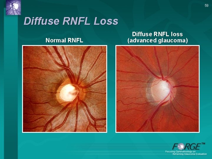59 Diffuse RNFL Loss Normal RNFL Diffuse RNFL loss (advanced glaucoma) 