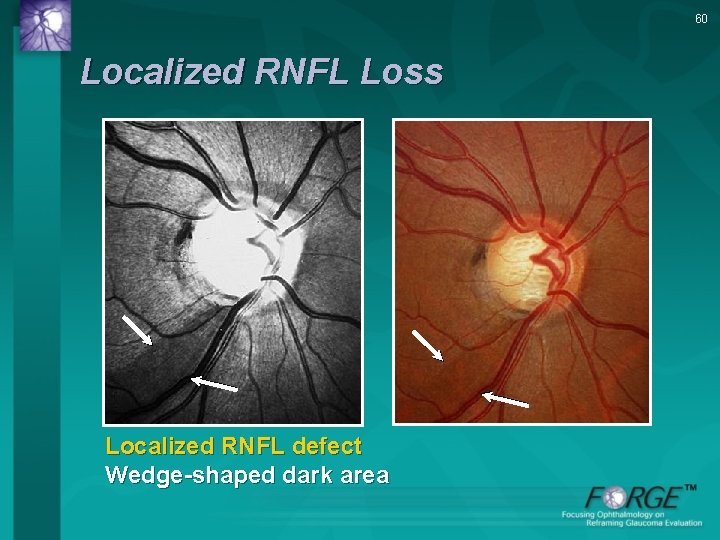 60 Localized RNFL Loss Localized RNFL defect Wedge-shaped dark area 