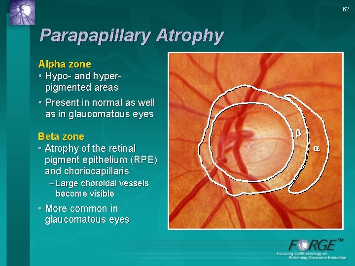 62 Parapapillary Atrophy Alpha zone • Hypo- and hyperpigmented areas • Present in normal