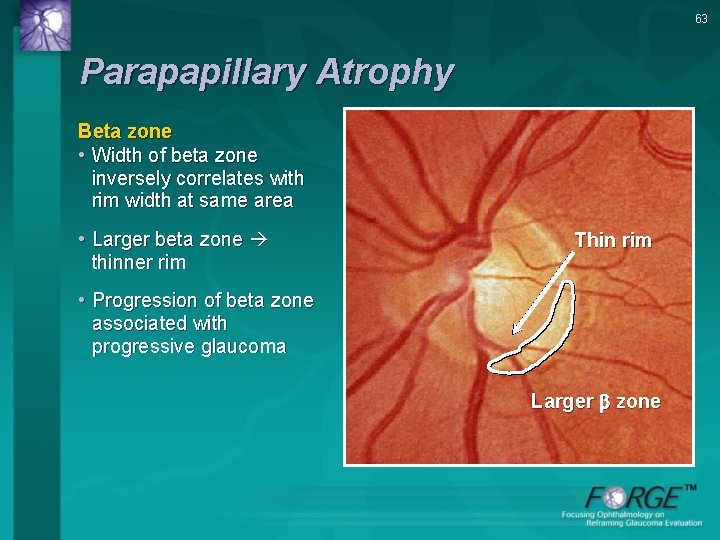 63 Parapapillary Atrophy Beta zone • Width of beta zone inversely correlates with rim
