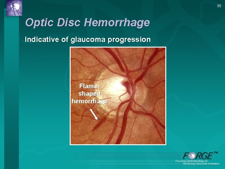 65 Optic Disc Hemorrhage Indicative of glaucoma progression Flameshaped hemorrhage 