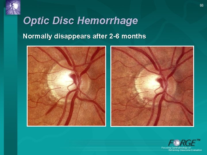 66 Optic Disc Hemorrhage Normally disappears after 2 -6 months 