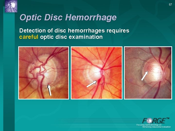 67 Optic Disc Hemorrhage Detection of disc hemorrhages requires careful optic disc examination 