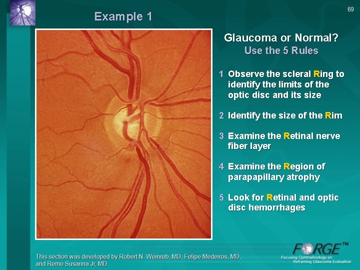 69 Example 1 Glaucoma or Normal? Use the 5 Rules 1 Observe the scleral