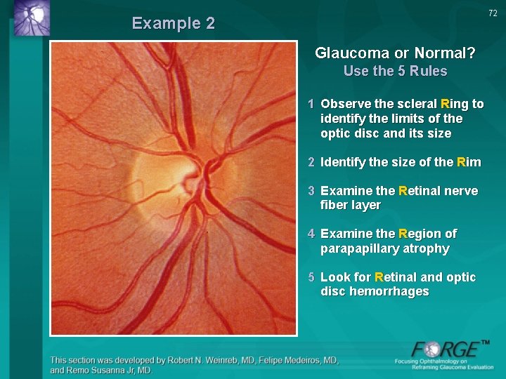 72 Example 2 Glaucoma or Normal? Use the 5 Rules 1 Observe the scleral