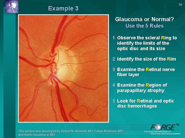 74 Example 3 Glaucoma or Normal? Use the 5 Rules 1 Observe the scleral
