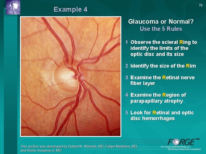 76 Example 4 Glaucoma or Normal? Use the 5 Rules 1 Observe the scleral