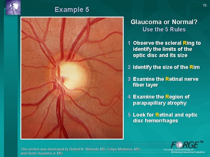 78 Example 5 Glaucoma or Normal? Use the 5 Rules 1 Observe the scleral