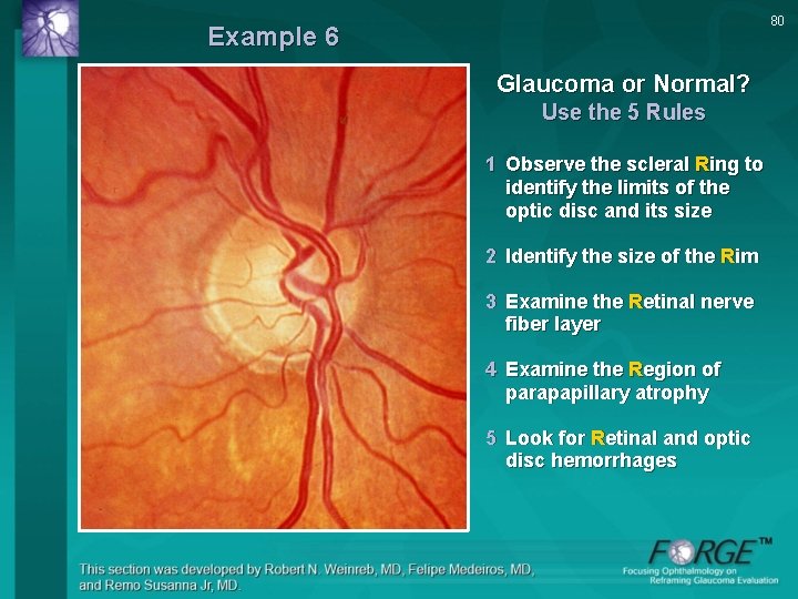 80 Example 6 Glaucoma or Normal? Use the 5 Rules 1 Observe the scleral