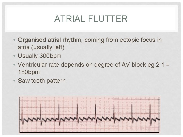 ATRIAL FLUTTER • Organised atrial rhythm, coming from ectopic focus in atria (usually left)