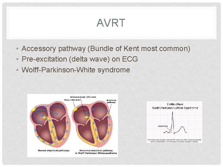 AVRT • Accessory pathway (Bundle of Kent most common) • Pre-excitation (delta wave) on