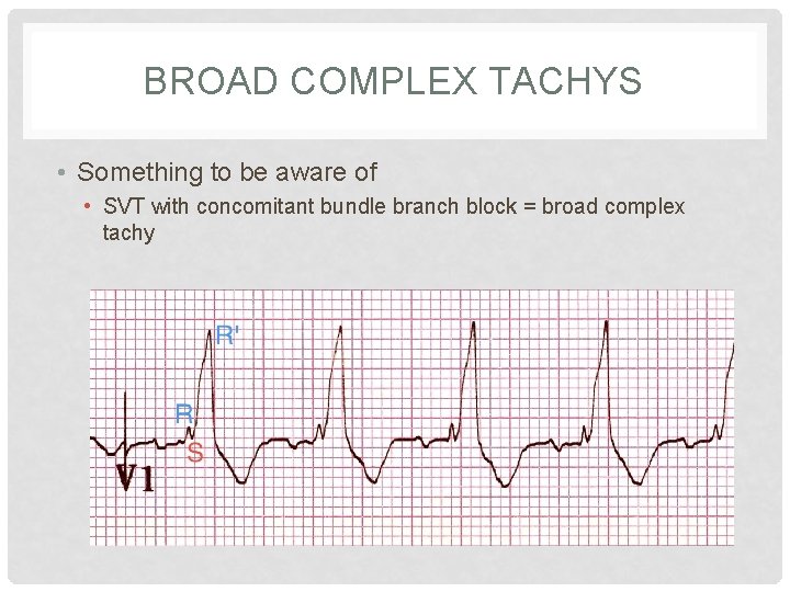 BROAD COMPLEX TACHYS • Something to be aware of • SVT with concomitant bundle