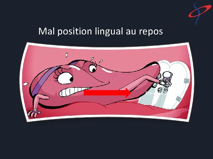 Mal position lingual au repos Pression linguale 